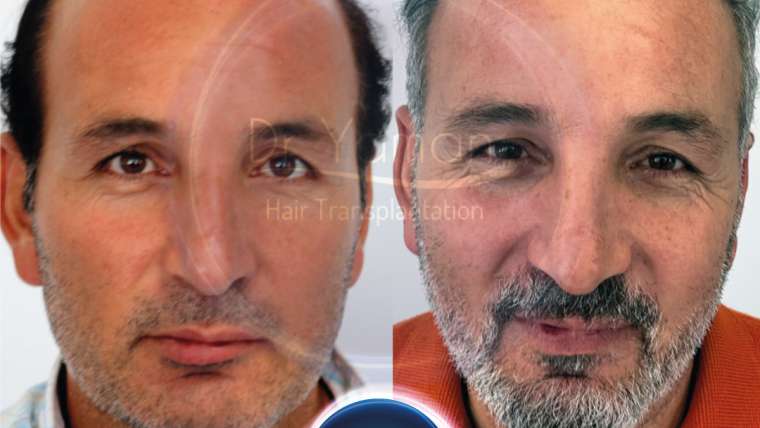Dr Resul Yaman Hair Clinic - 4810 Grafts - 5 Years Result