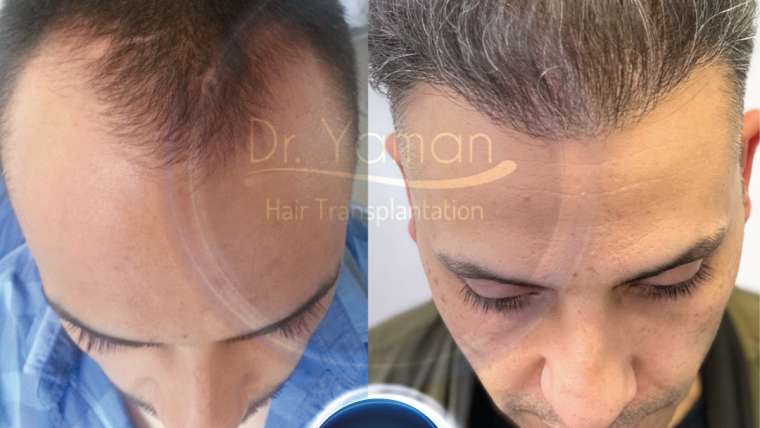 Dr Resul Yaman Hair Clinic - 3100 Grafts - 10 Years Result