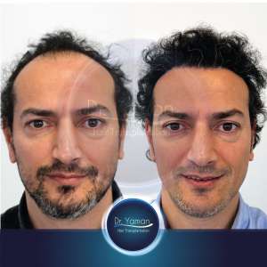 Dr Resul Yaman Hair Clinic - 3920 Grafts - 9 Months Result