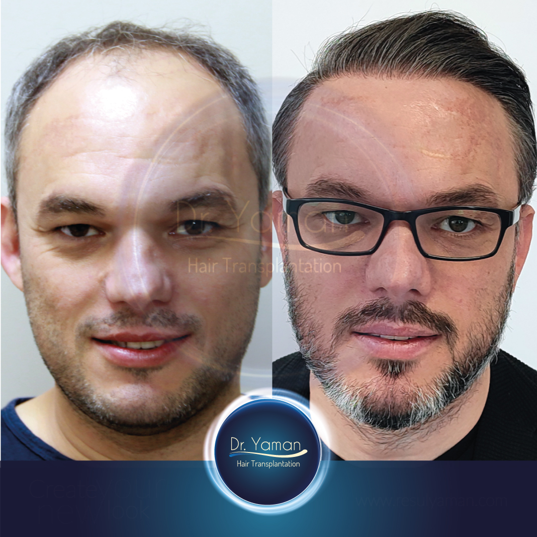 Dr Resul Yaman Hair Clinic - 4950 Grafts - 7 Years Result