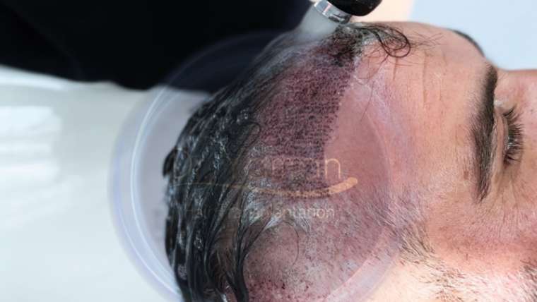 Lavar o cabelo após o transplante capilar