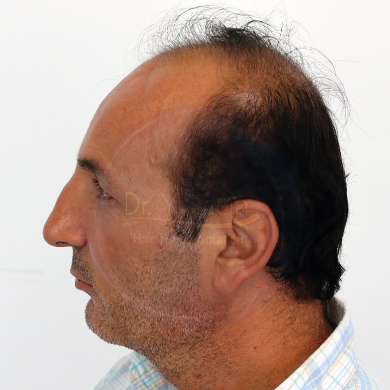 4810 Grafts - 5 Years Result | Dr Resul Yaman - Hair Clinic