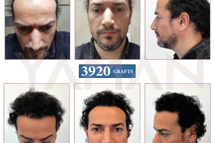 3920 Grafts hair transplant – 9 Months Result