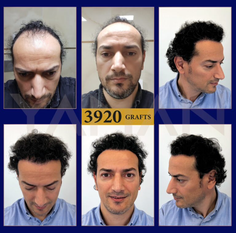 3920 Grafts hair transplant