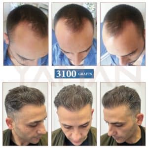 What is Norwood 3 Hair Loss? Why Should You Choose Turkey for Nw 3 Balding Treatment?