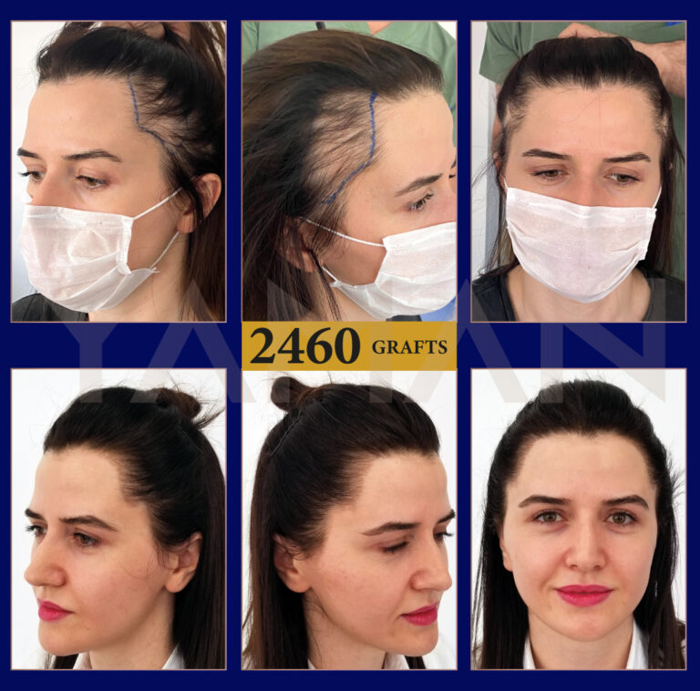 2460 Grafts Woman Hair Transplant Result