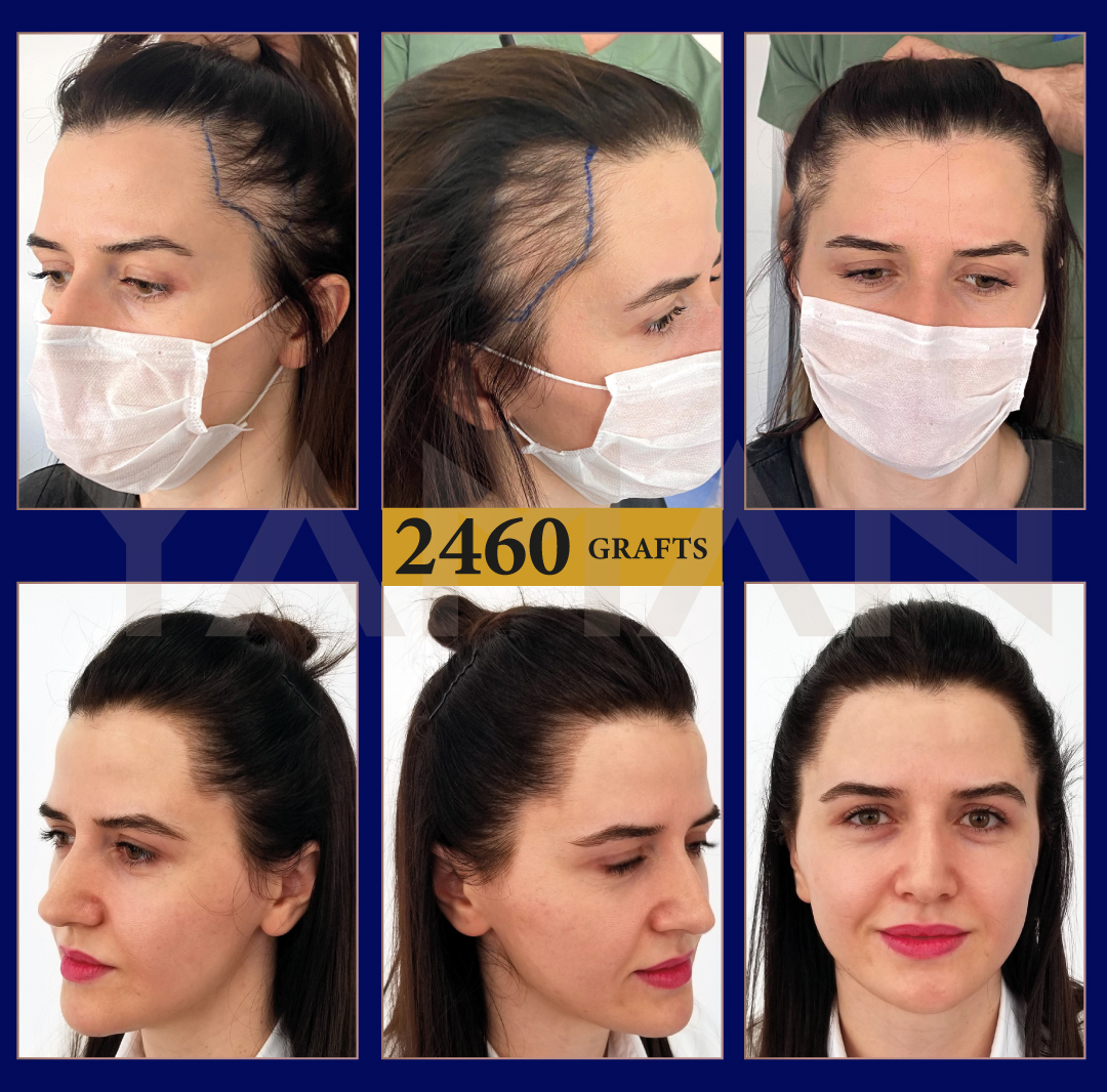 2460 Grafts Woman Hair Transplant Result