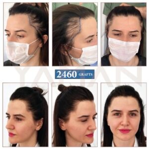 2460 Grafts Before - After