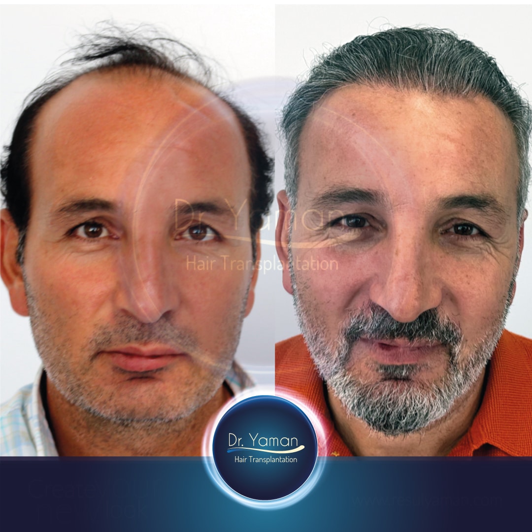 Dr Resul Yaman Hair Clinic - 4810 Grafts - 5 Years Result