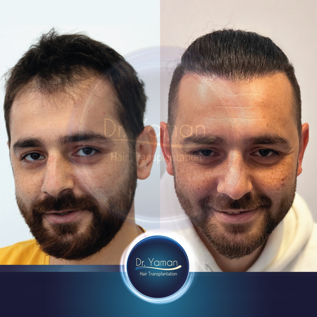 Dr Resul Yaman Hair Clinic - 2890 Grafts - 17 Months Result