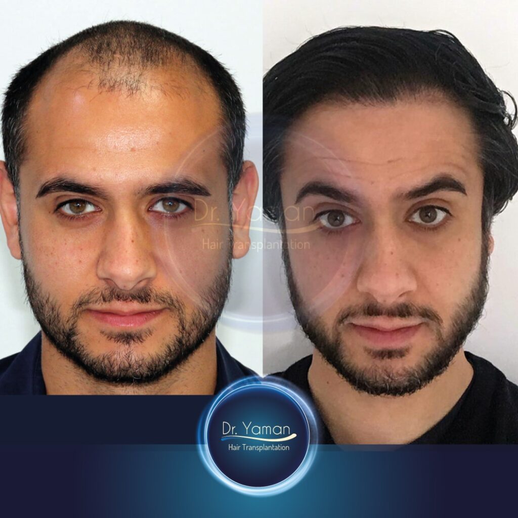 before procedure