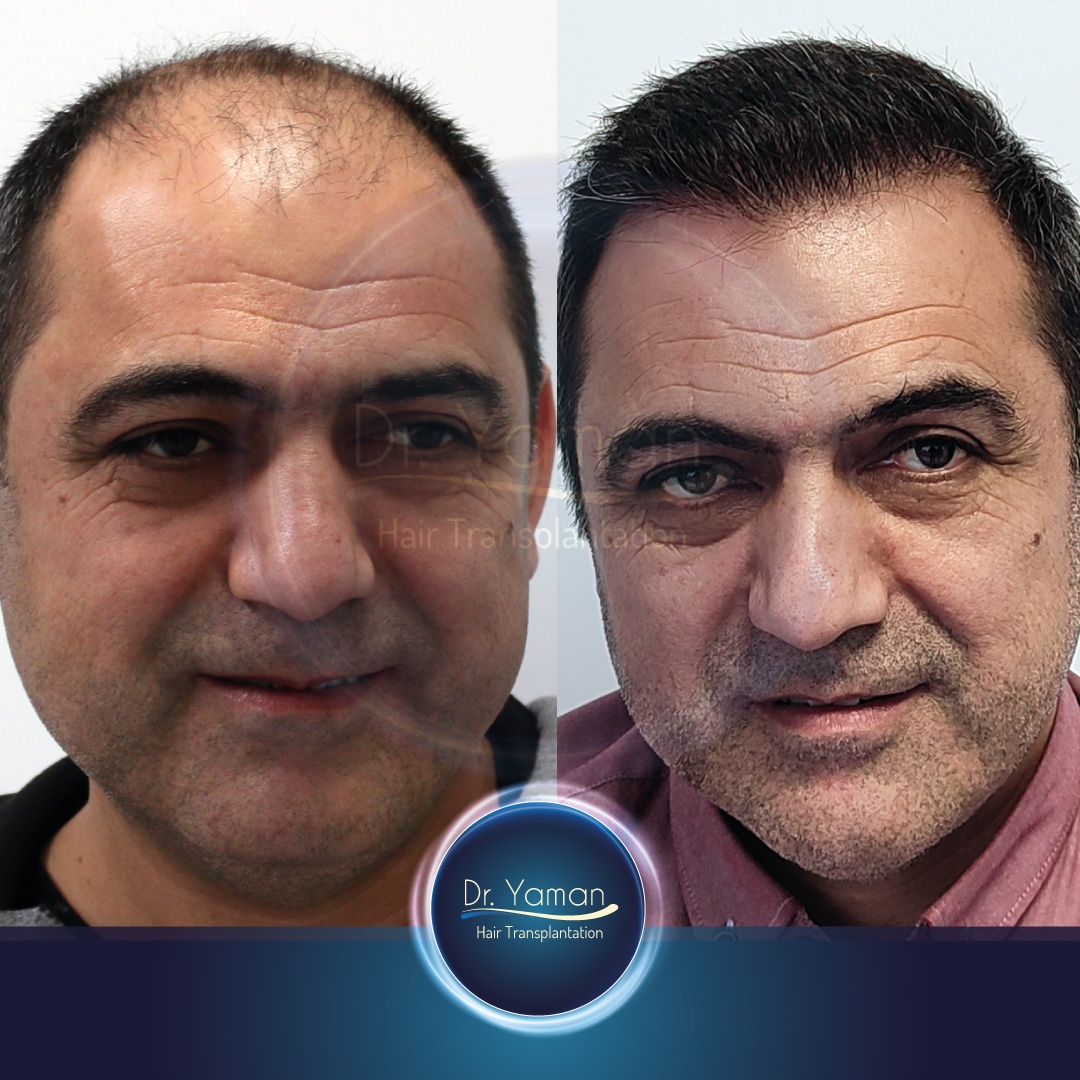 4670 Grafts Before - After