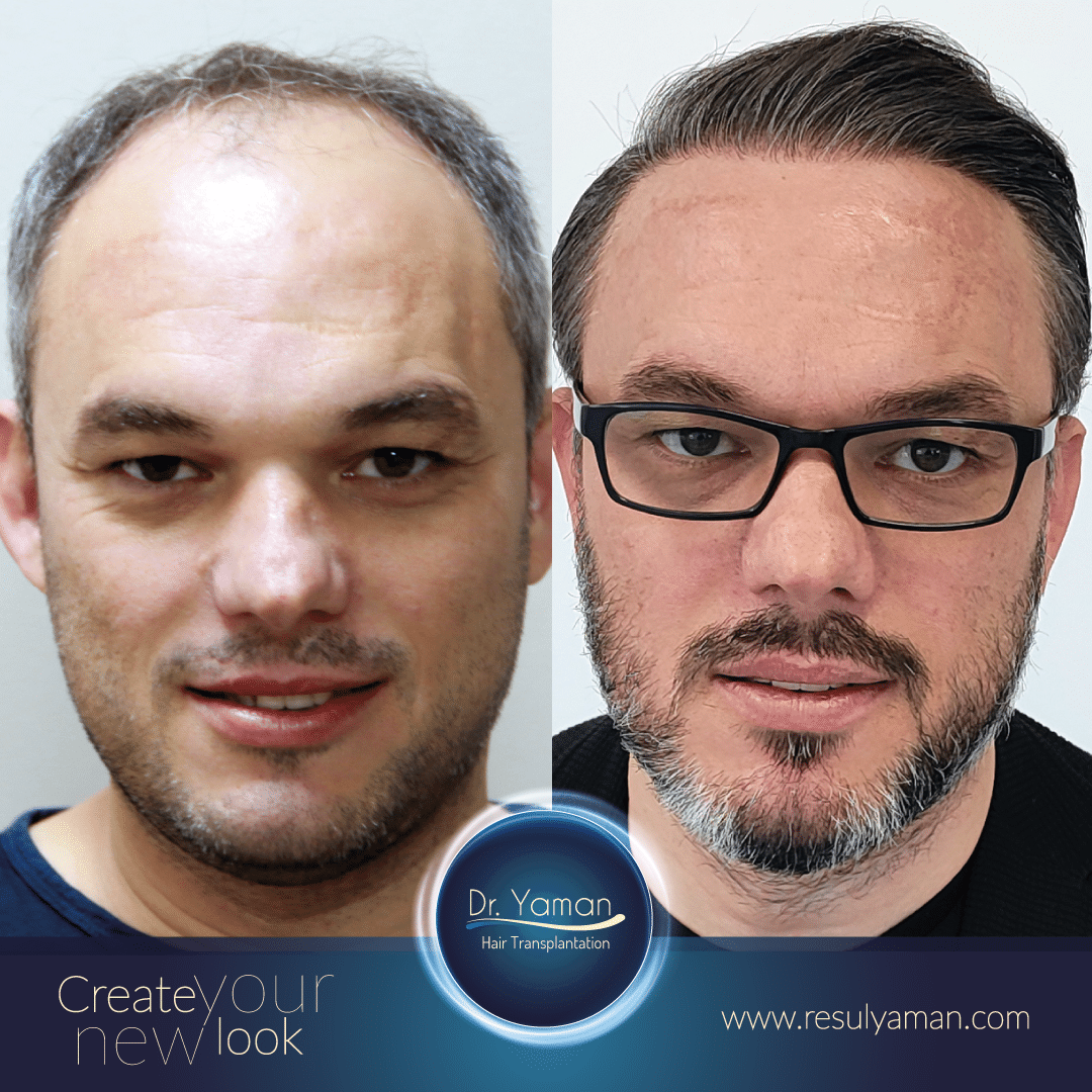 Hair Transplant Results After 3 Months | Hair Growth, Images & Effects