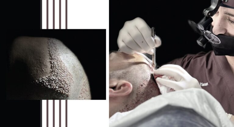 turkey hair transplant cost