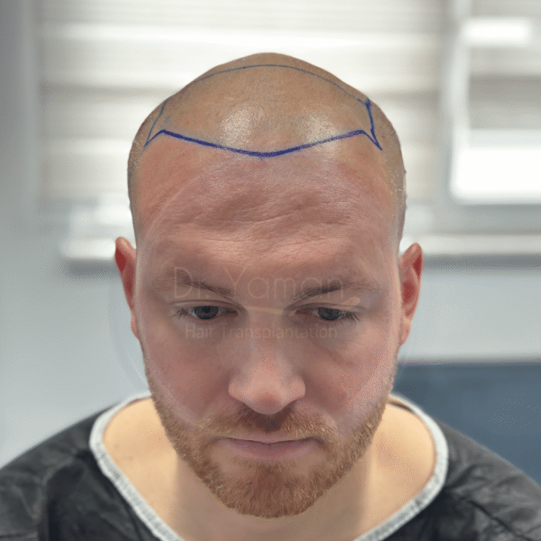 fue hair transplant turkey