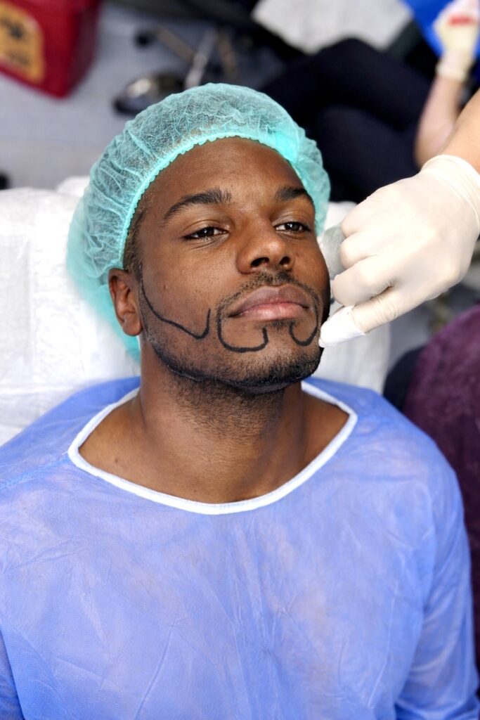 Beard Transplant