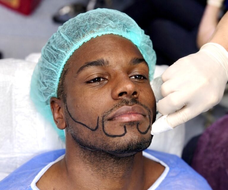 Beard Transplant