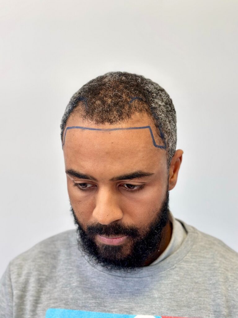 afro hair transplant