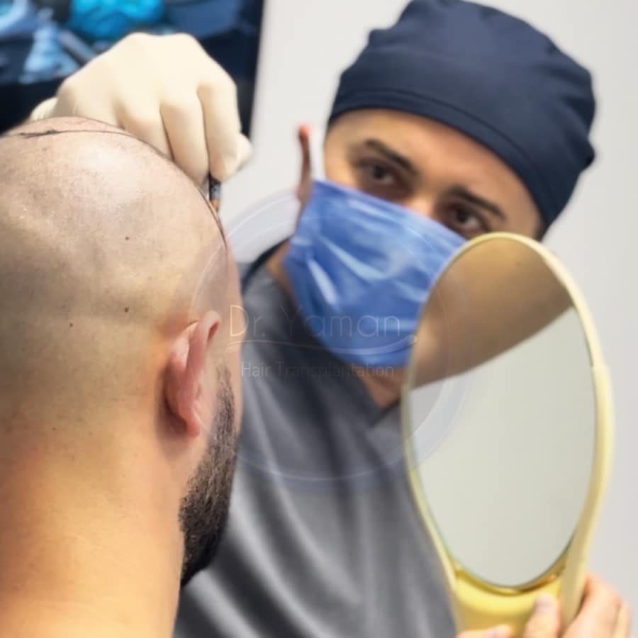 Hair transplant Turkey before and after