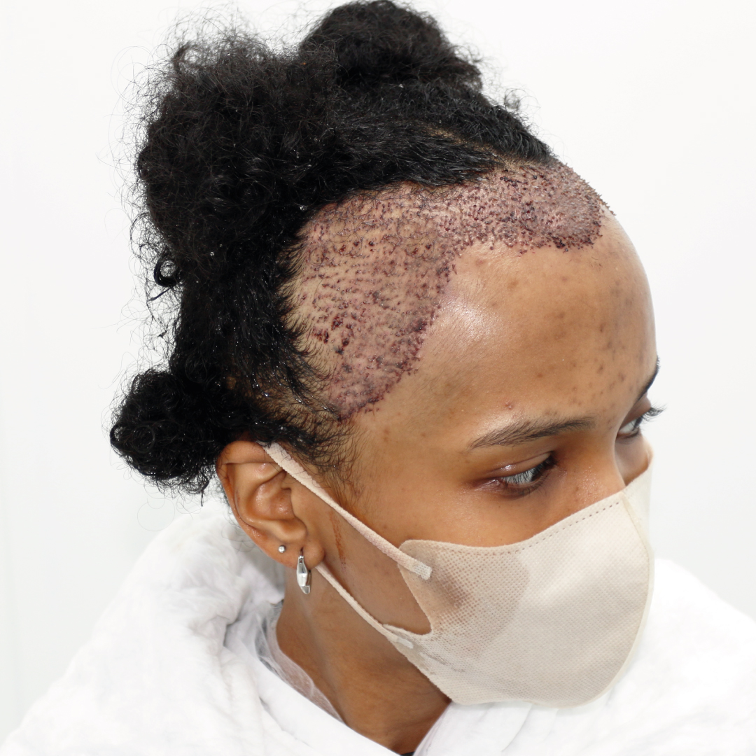 Afro hair transplant cost in Turkey