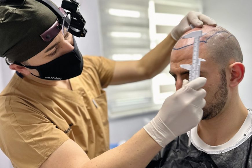 ¿Varían los costos del trasplante de cabello según la extensión de la pérdida de cabello o los resultados deseados?