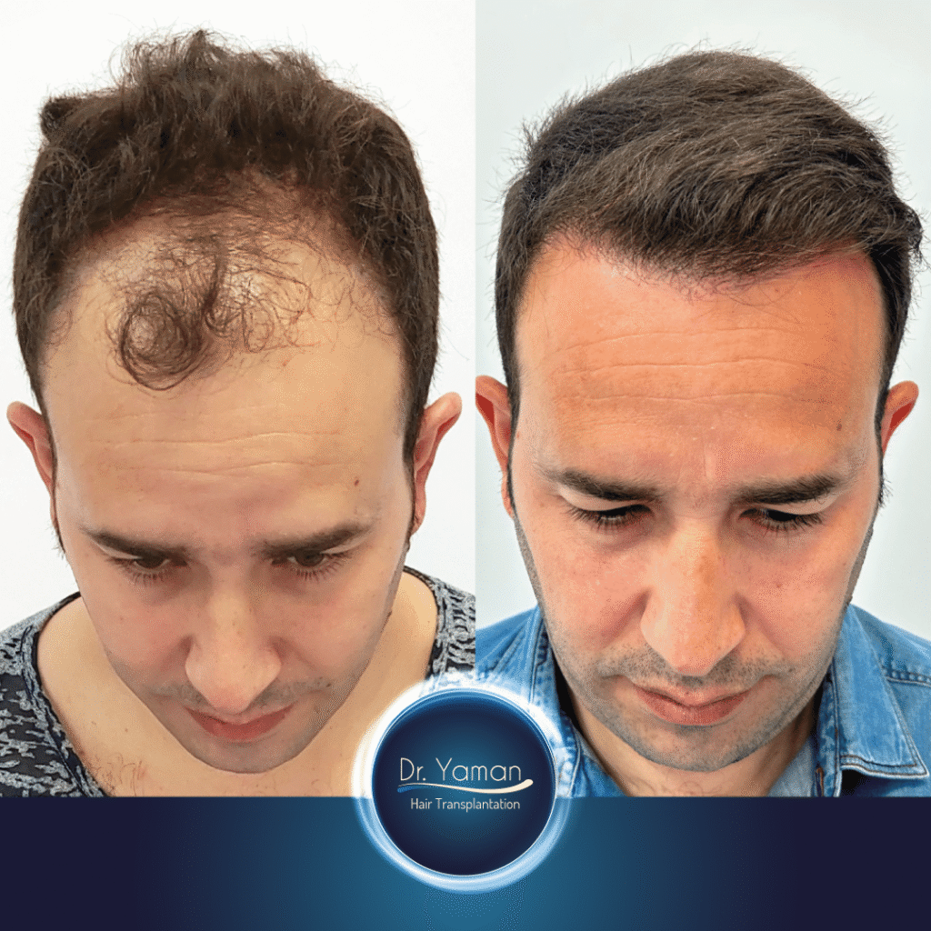 3560 grafts before and after