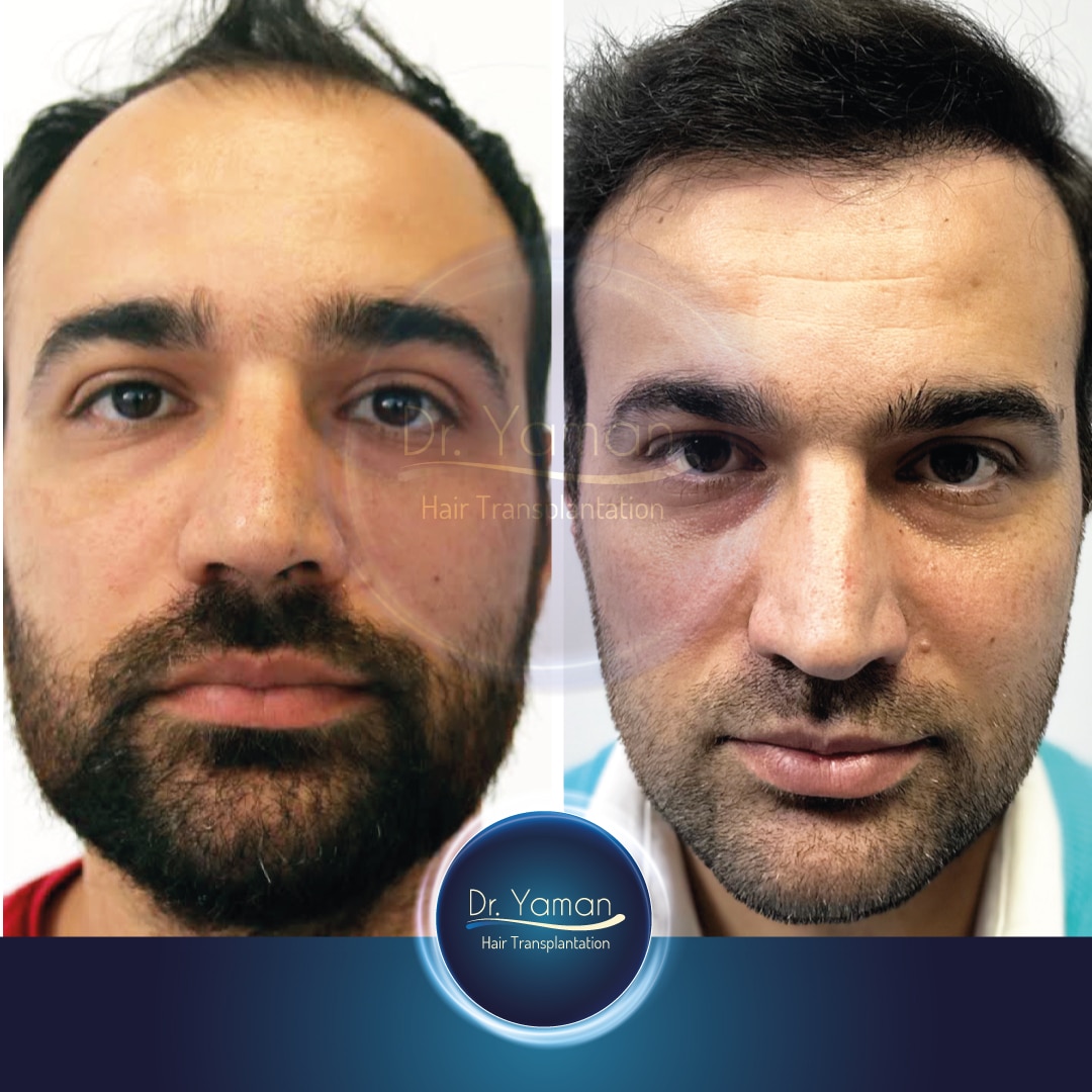 3810 Grafts Before – After