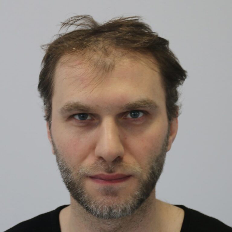 2615-grafts-before-and-after-dr-resul-yaman-hair-clinic