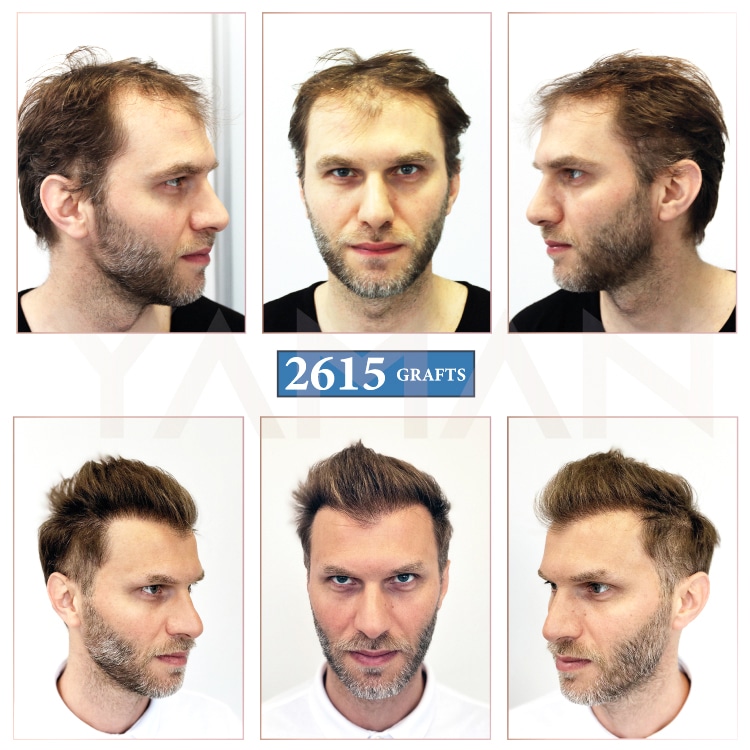 2615 Grafts Before and After