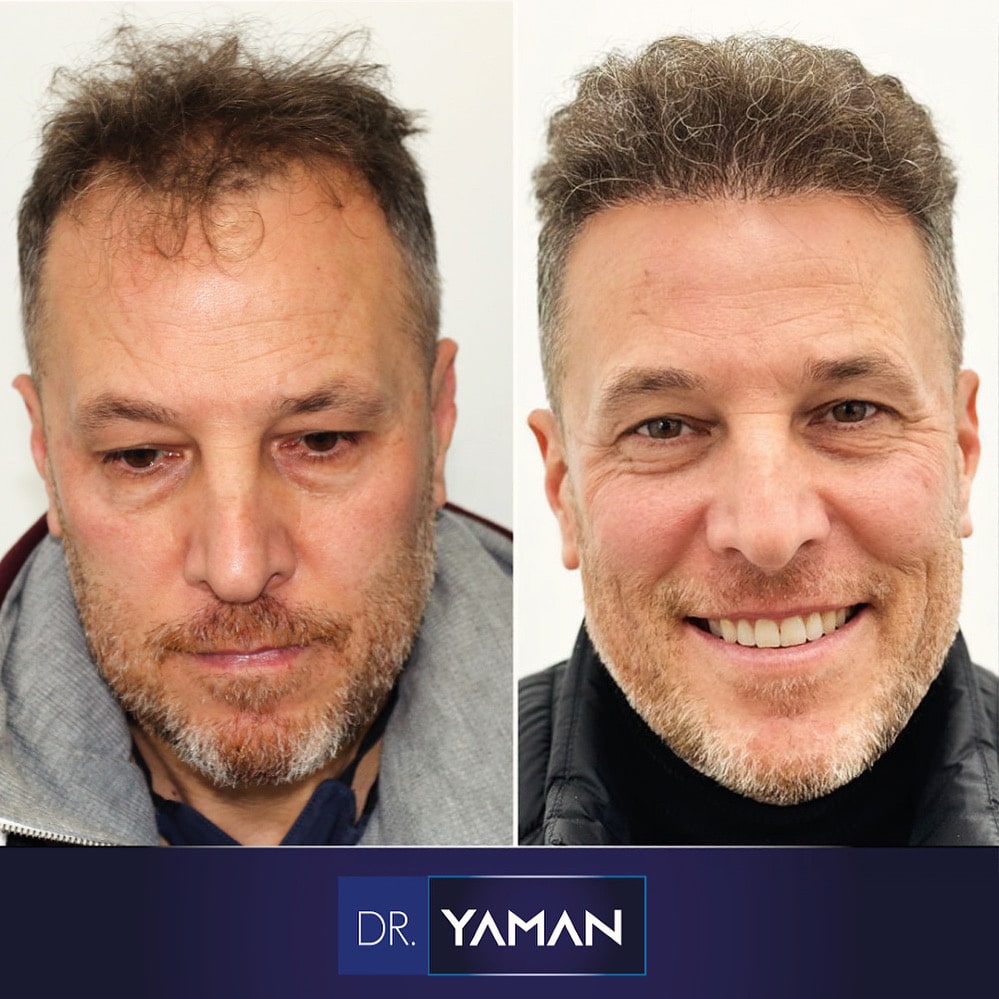 4760 Grafts Hair Transplant Before and After