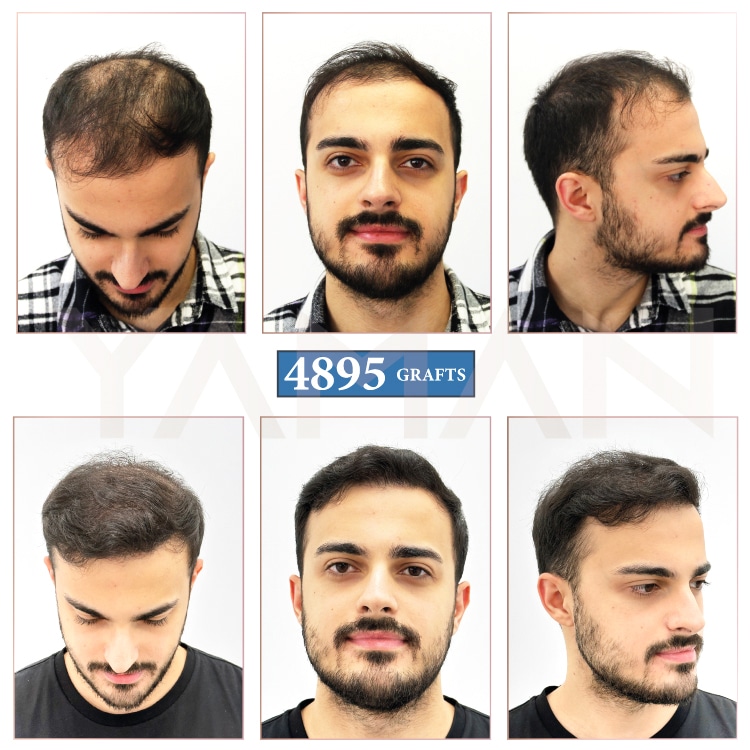 4895 Grafts Hair Transplant Before and After