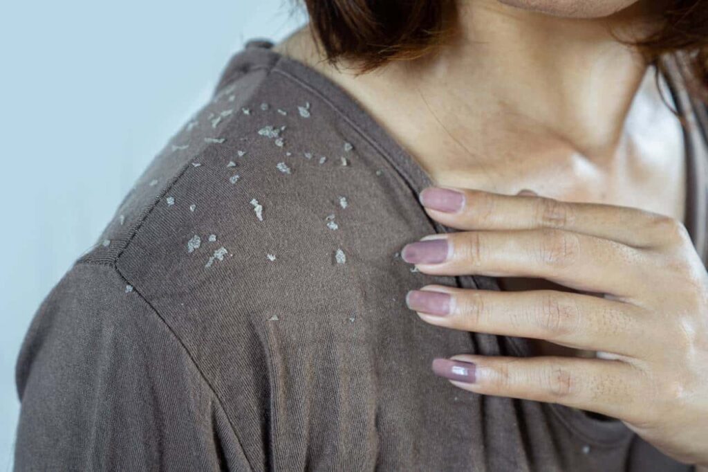 Can Dandruff Cause Hair Loss? - Dr. Resul Yaman