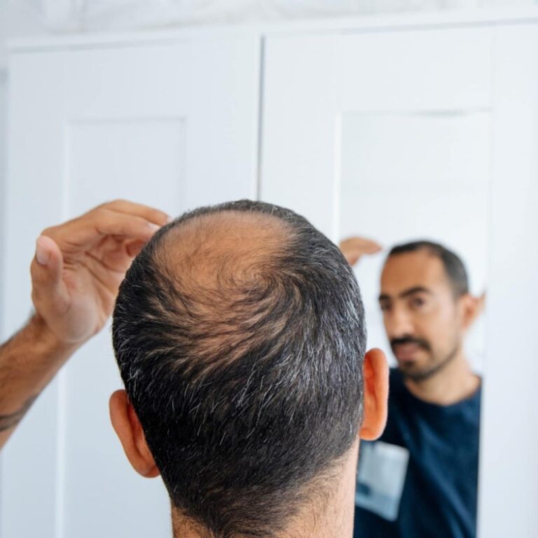 Bald man looking mirror at head baldness and hair loss