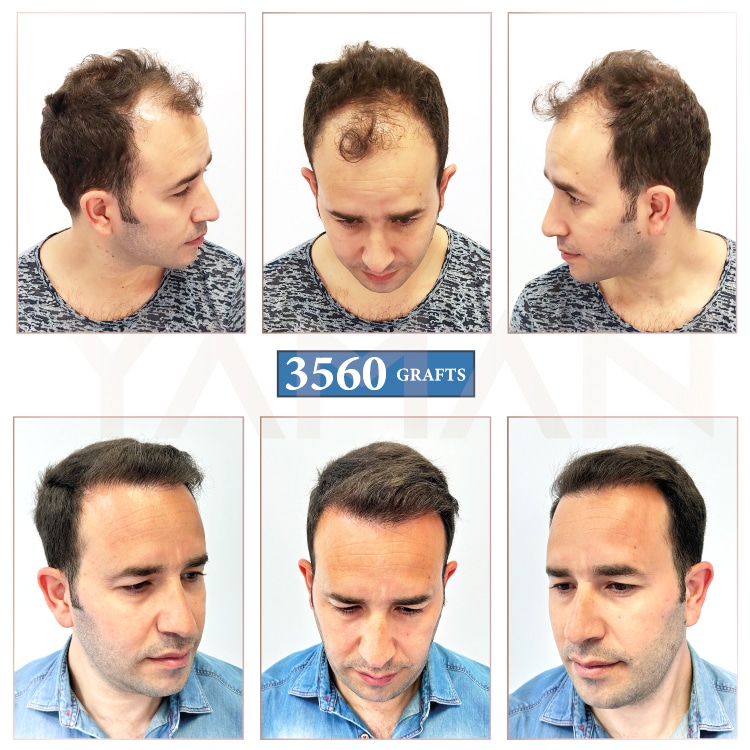 3560 Grafts Hair Transplant Before and After