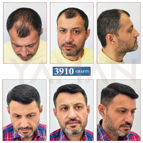 3910 Grafts Hair Transplant Before and After Results