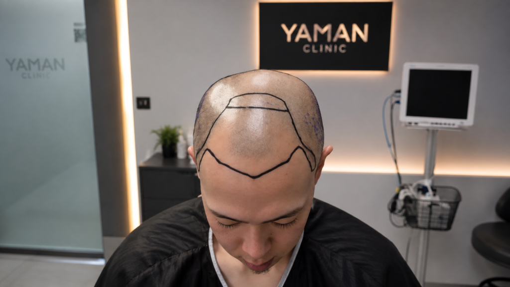 Asian Hair transplant