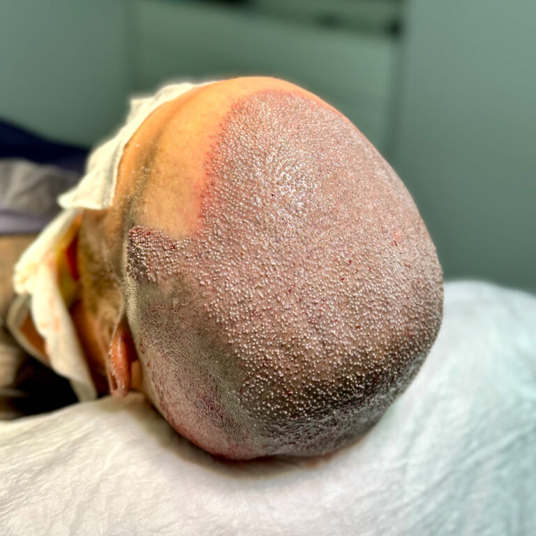 Mega Session Hair Transplant