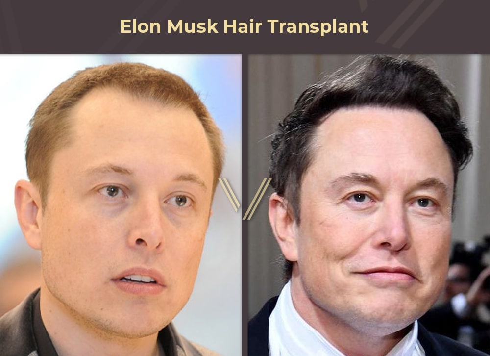 Greffe de cheveux d'Elon Musk - Dr Resul Yaman Hair Clinic