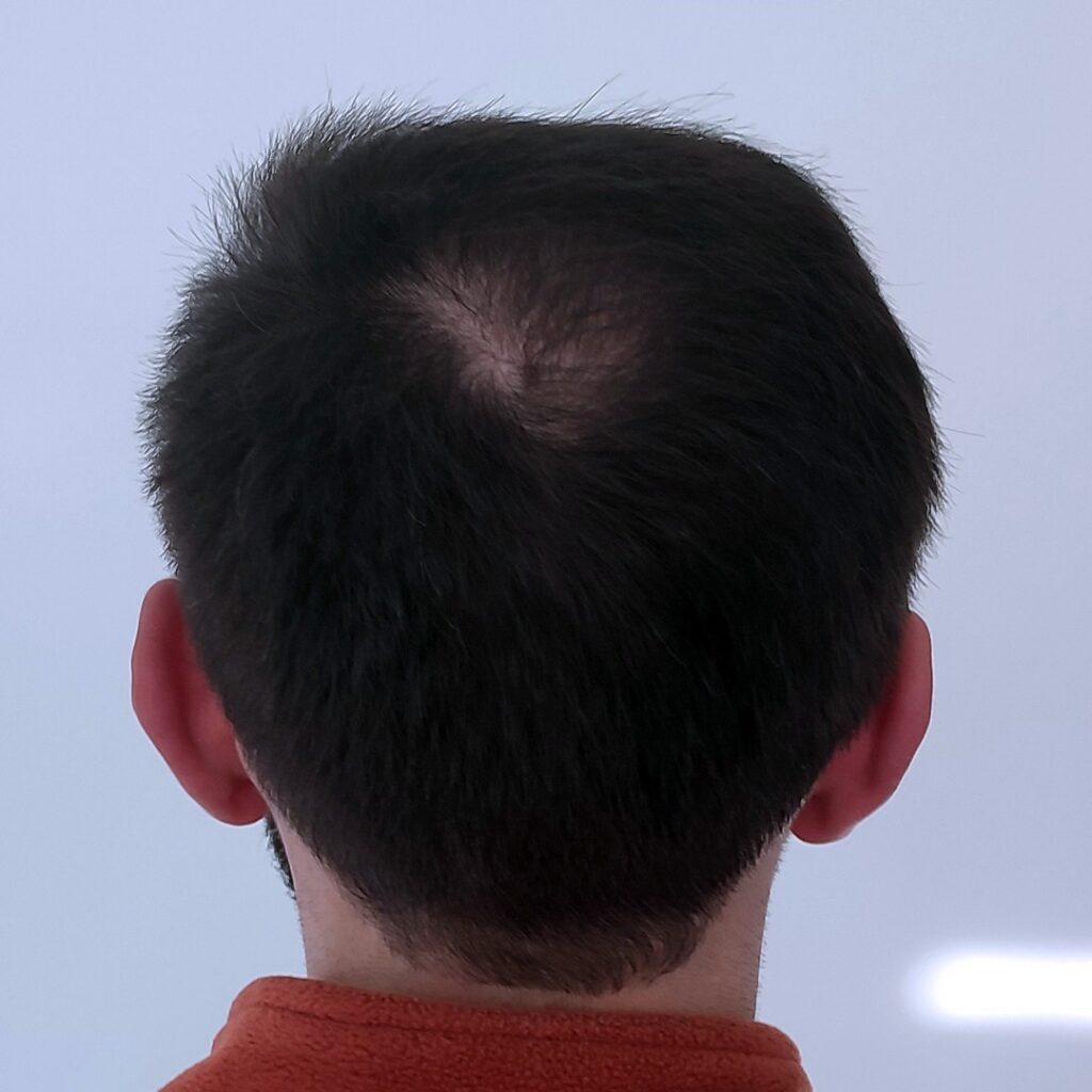 4280 grafts hair transplant before and after - patient photo 1