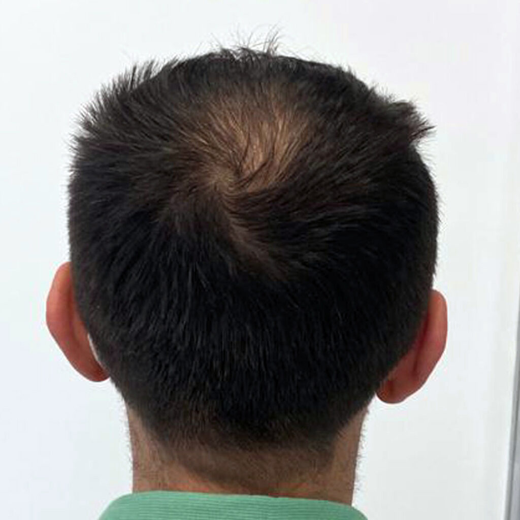4280 grafts hair transplant before and after - patient photo 2