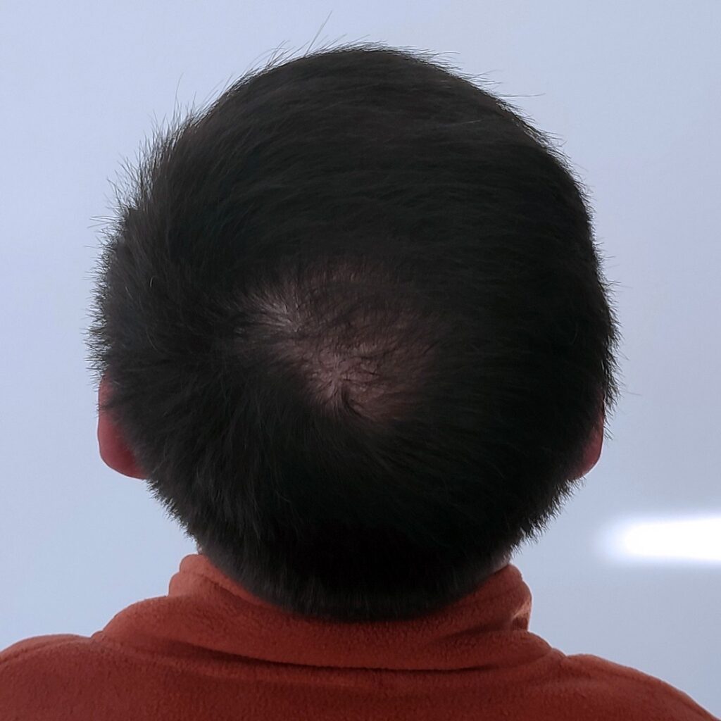 4280 grafts hair transplant before and after - patient photo 3
