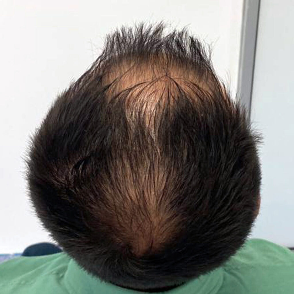 4280 grafts hair transplant before and after - patient photo 4