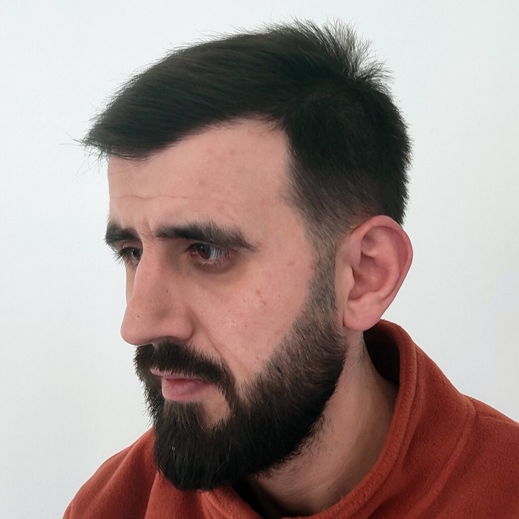 4280 grafts hair transplant before and after - patient photo 5