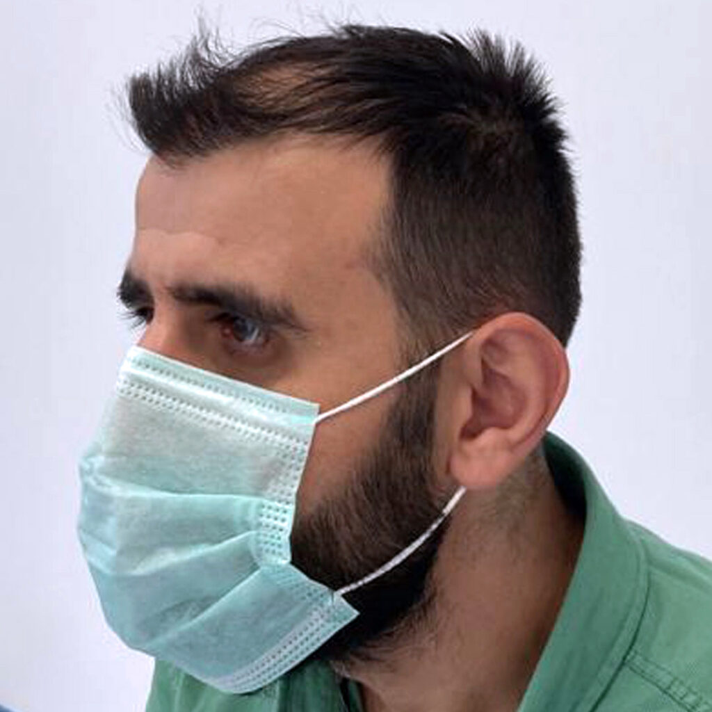 4280 grafts hair transplant before and after - patient photo 6