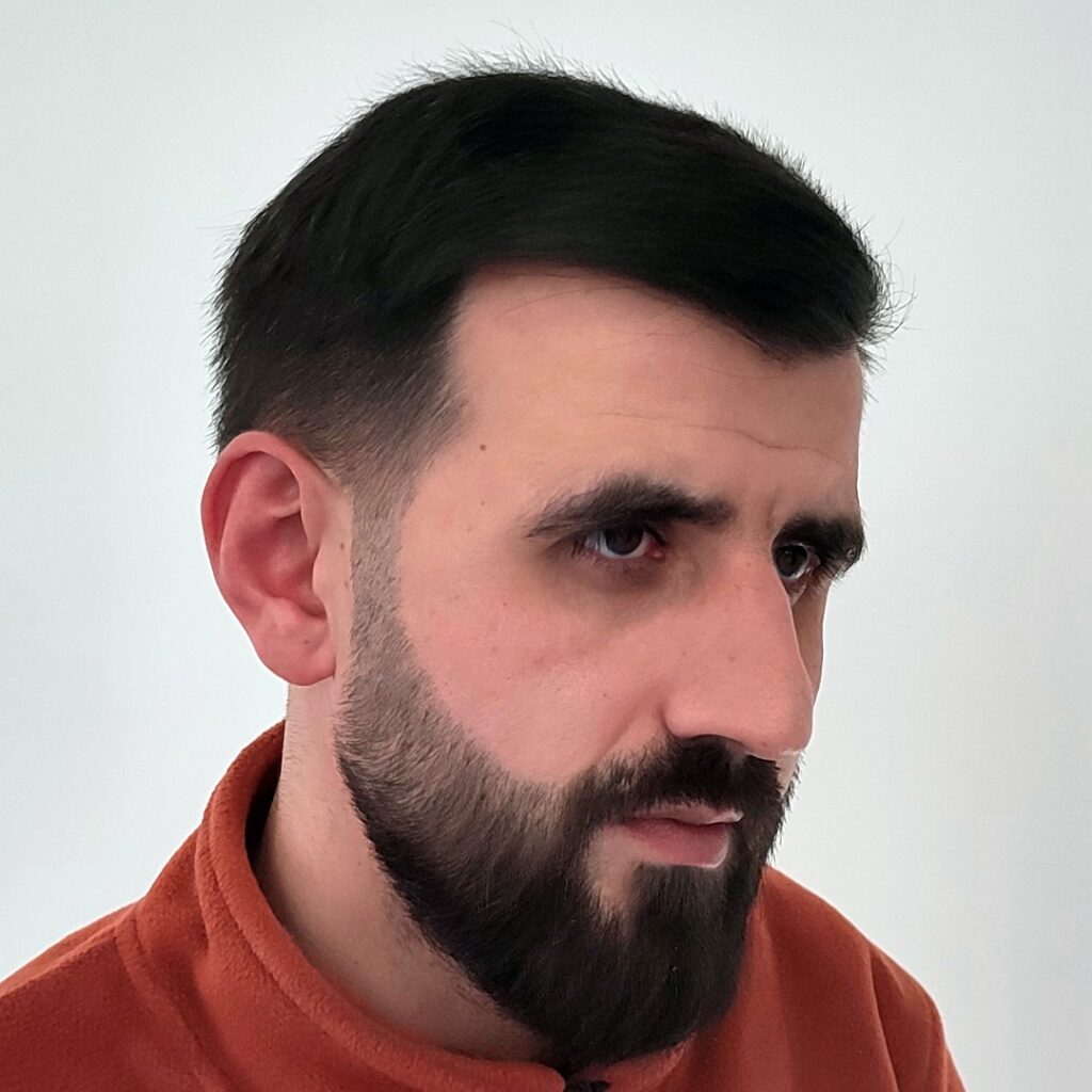 4280 grafts hair transplant before and after - patient photo 7