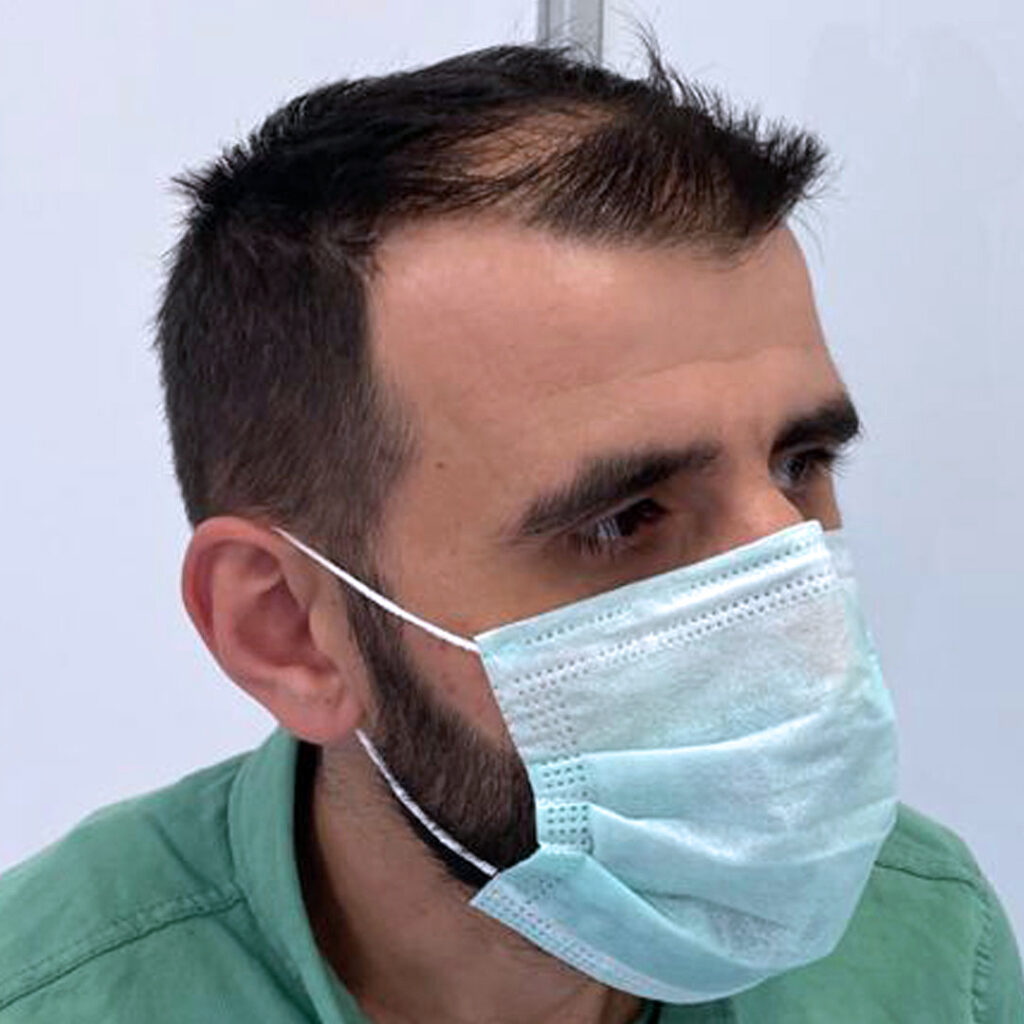 4280 grafts hair transplant before and after - patient photo 8