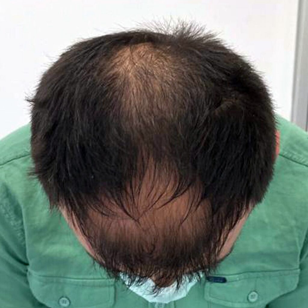 4280 grafts hair transplant before and after - patient photo 9