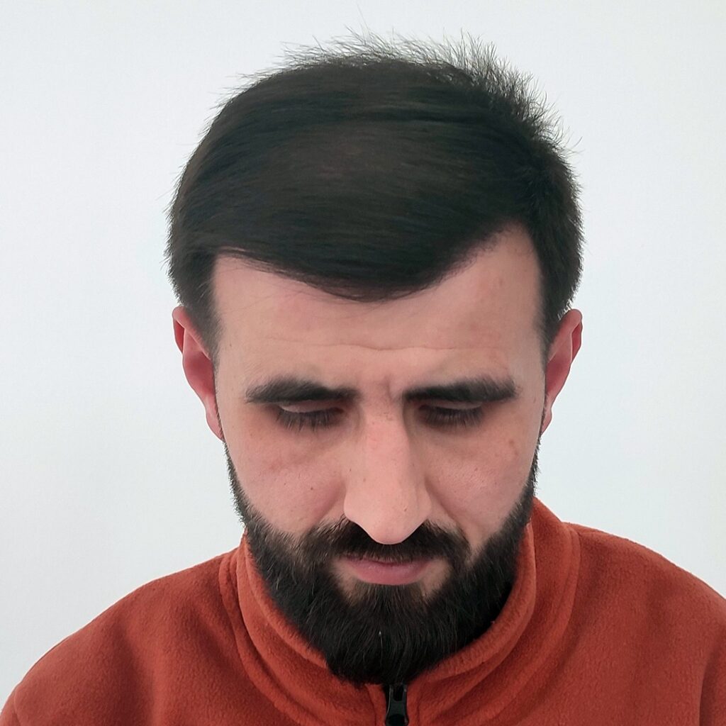 4280 grafts hair transplant before and after - patient photo 10