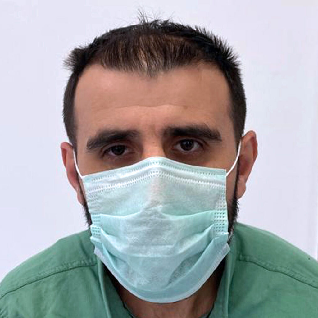 4280 grafts hair transplant before and after - patient photo 12