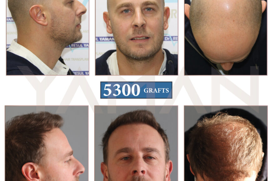 5300 Grafts vor und nach der Haartransplantation